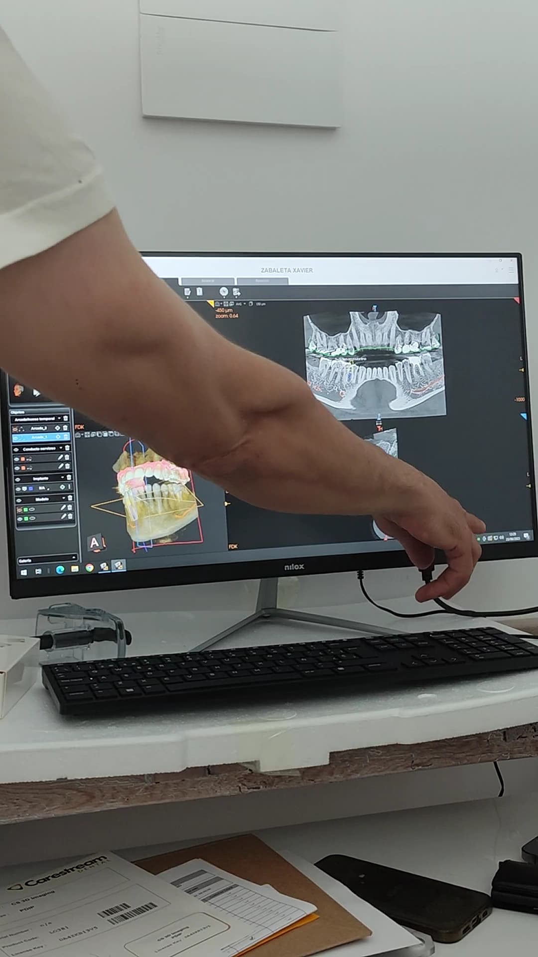 Planificación digital en 3D en la consulta de OdontoSmile